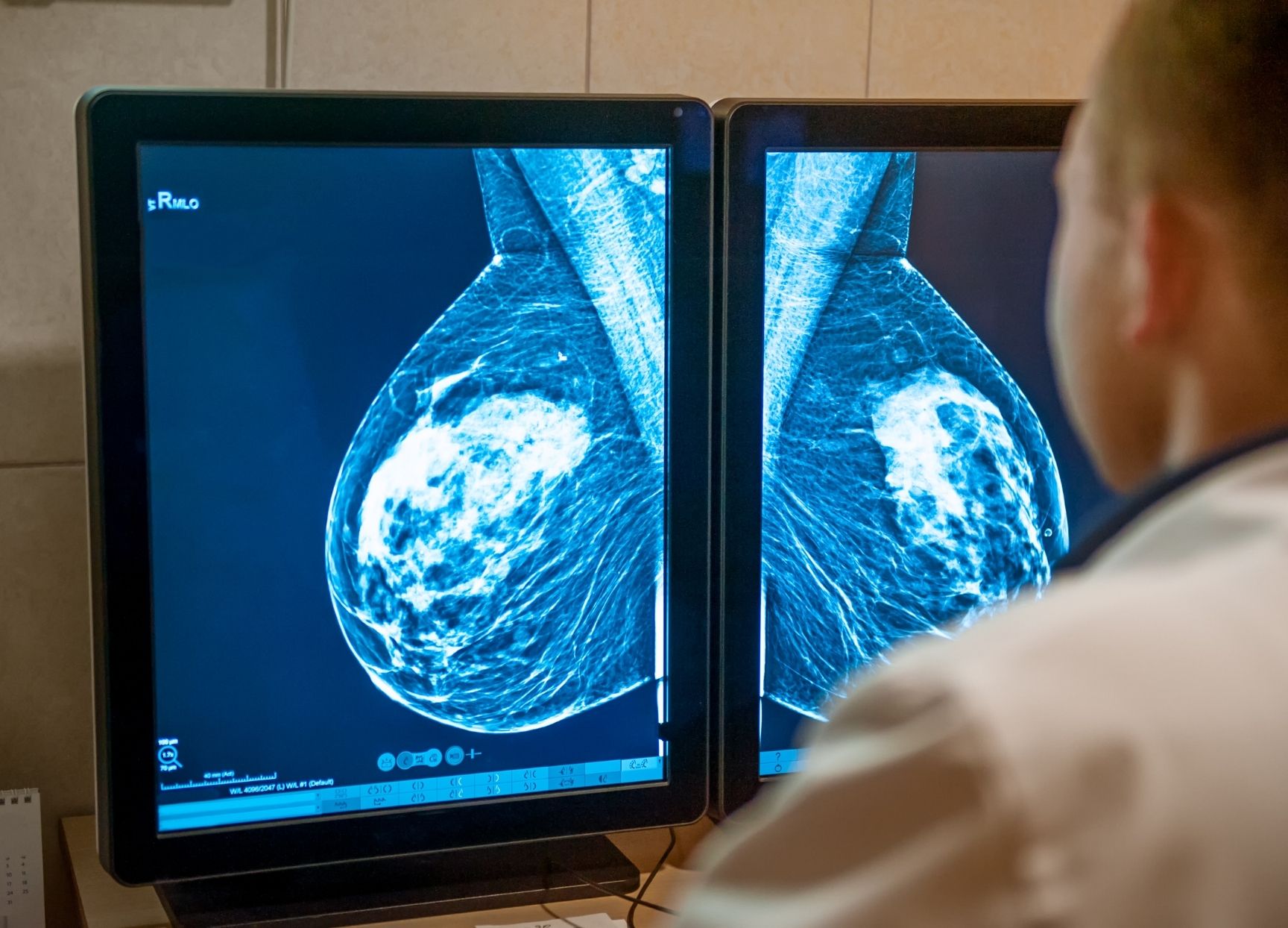 Mammogram Imaging