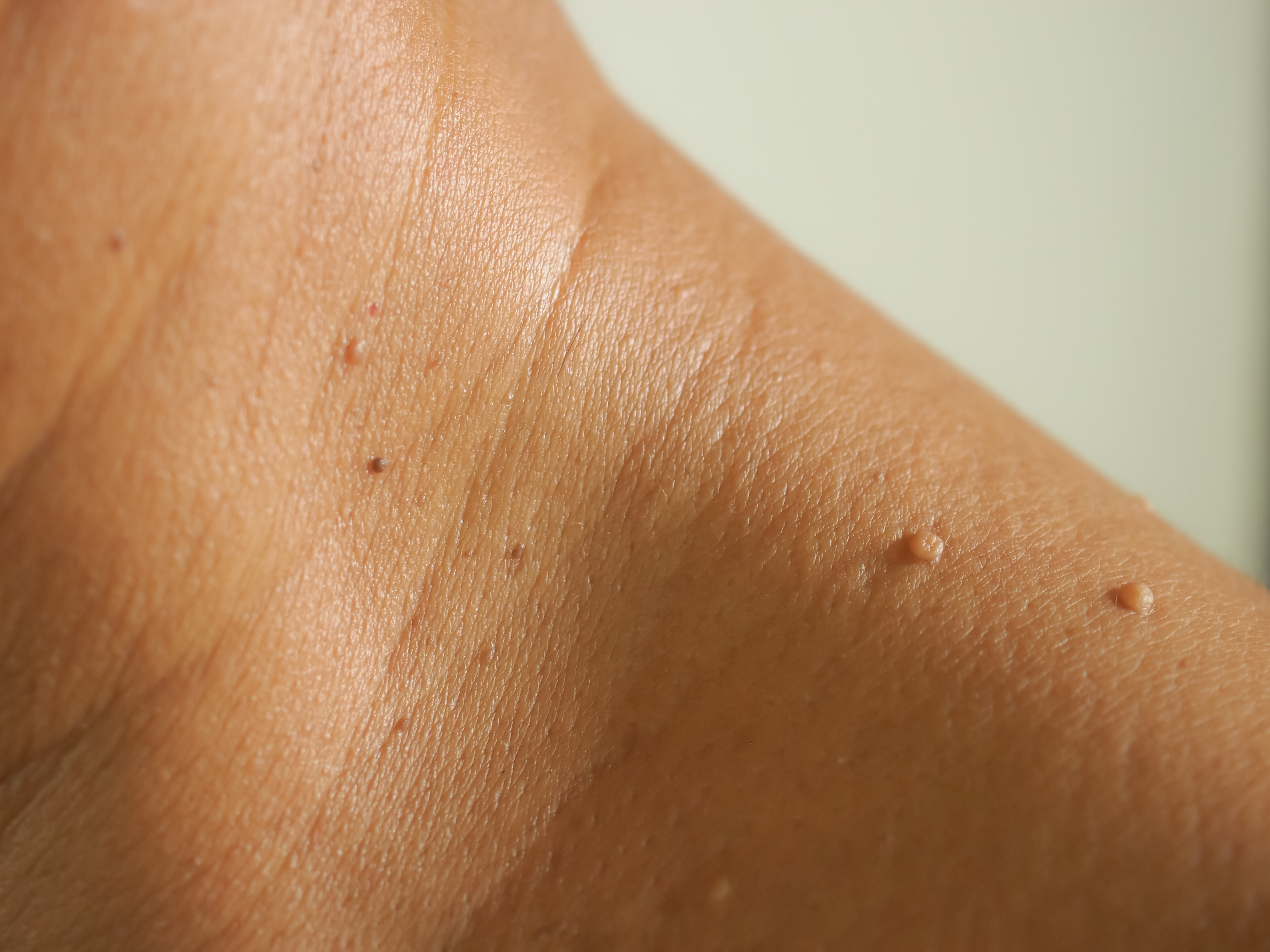 Skin Tags: What Is The Skin Tag Removal Healing Time & Will They Come Back?