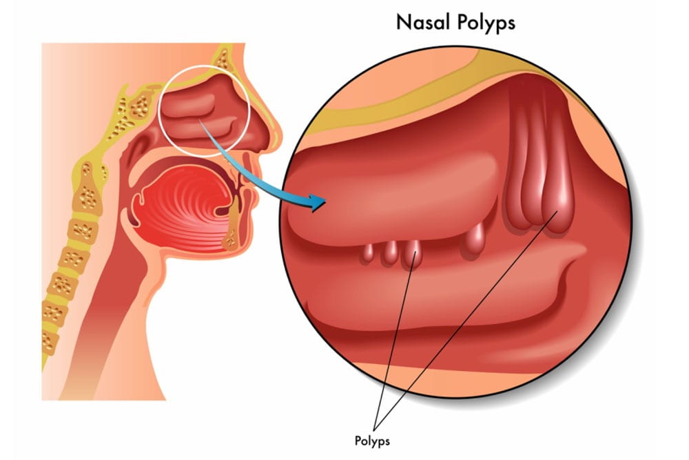 Diagram of nasal polyps 