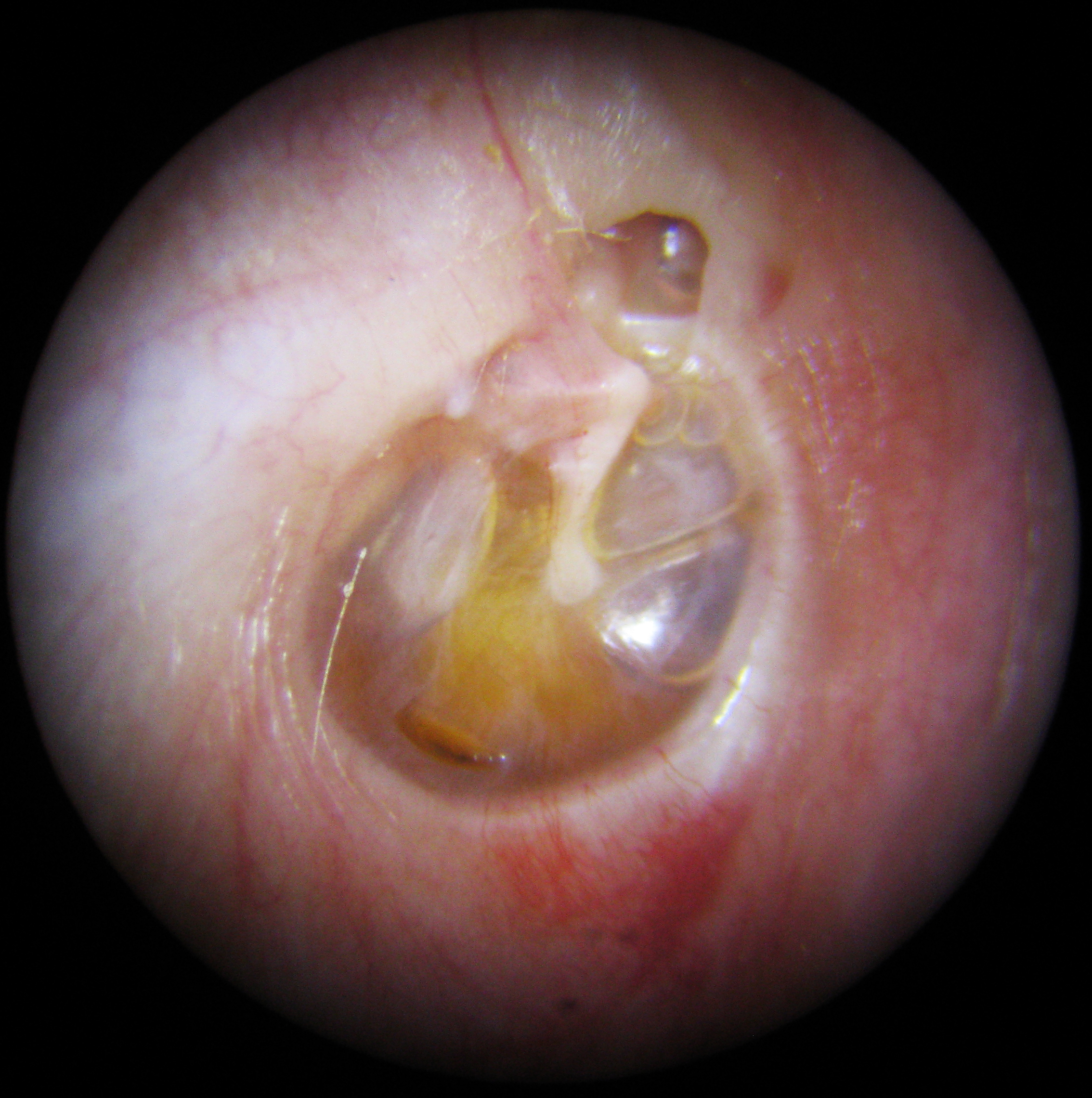 Glue Ear