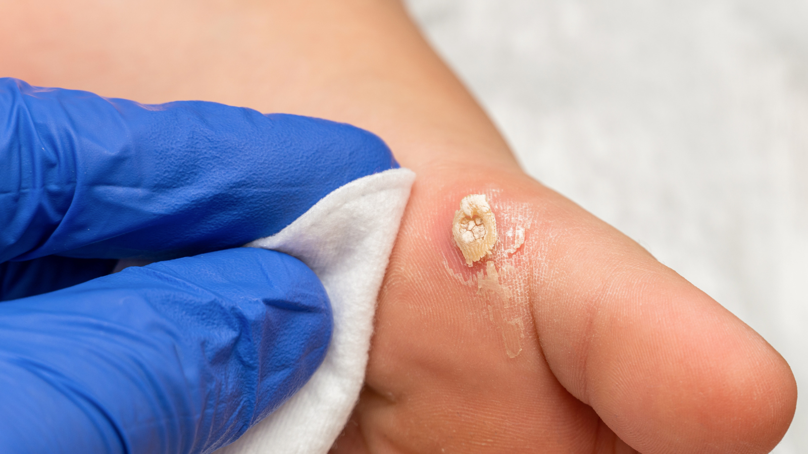 Warts Dermatology OneWelbeck Skin Health Allergy