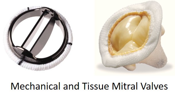 heart-murmurs-aortic-mitral-stenosis-regurgitation-how-to-identify