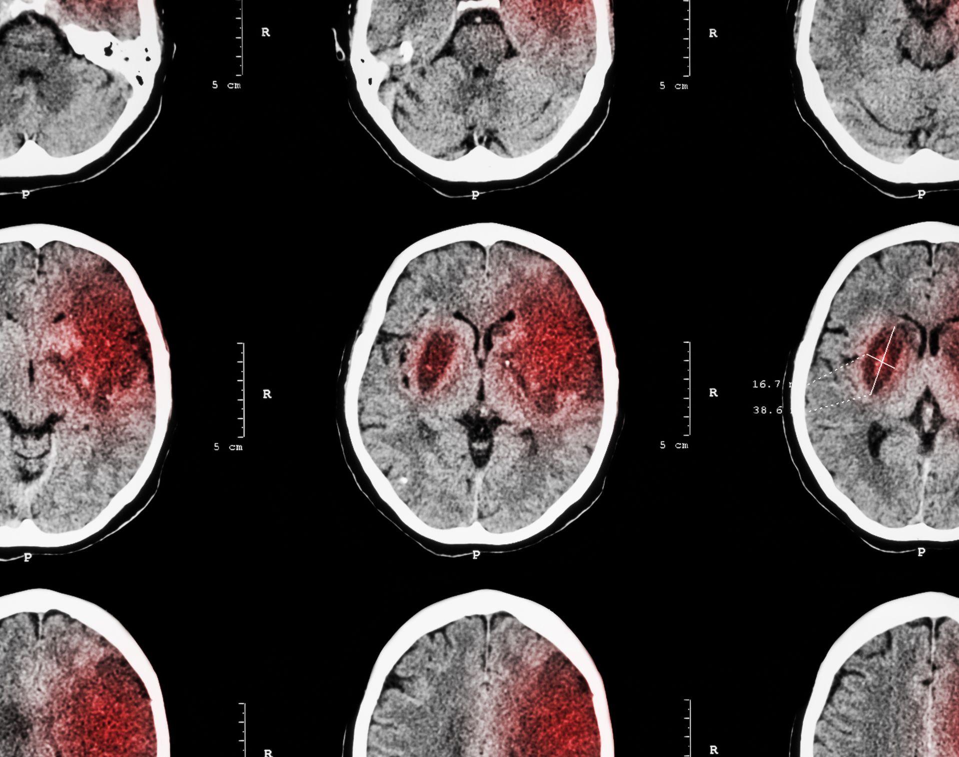 Stroke and vascular disorders