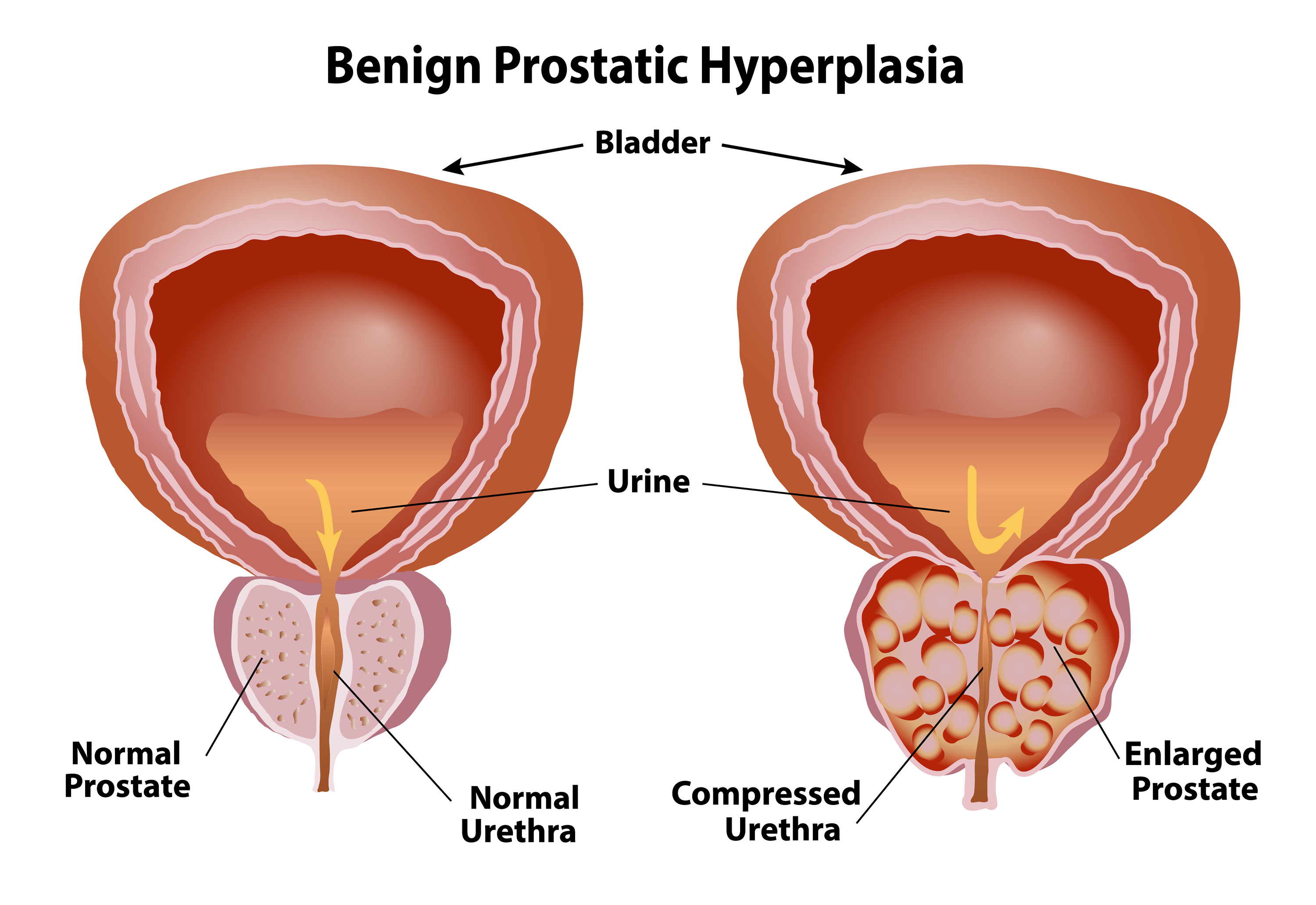 BPH Enlarged Prostate - OneWelbeck