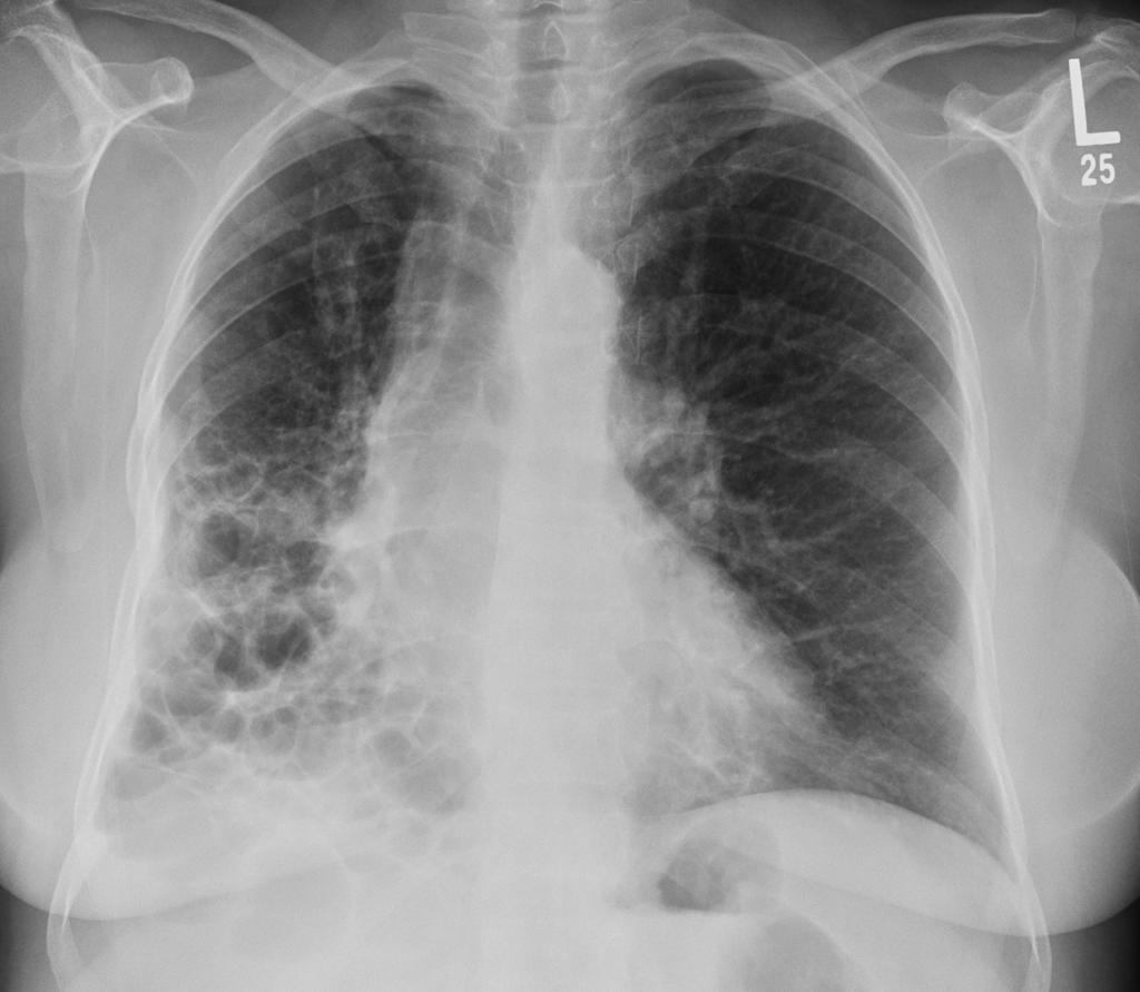 Interstitial Lung Disease X Ray