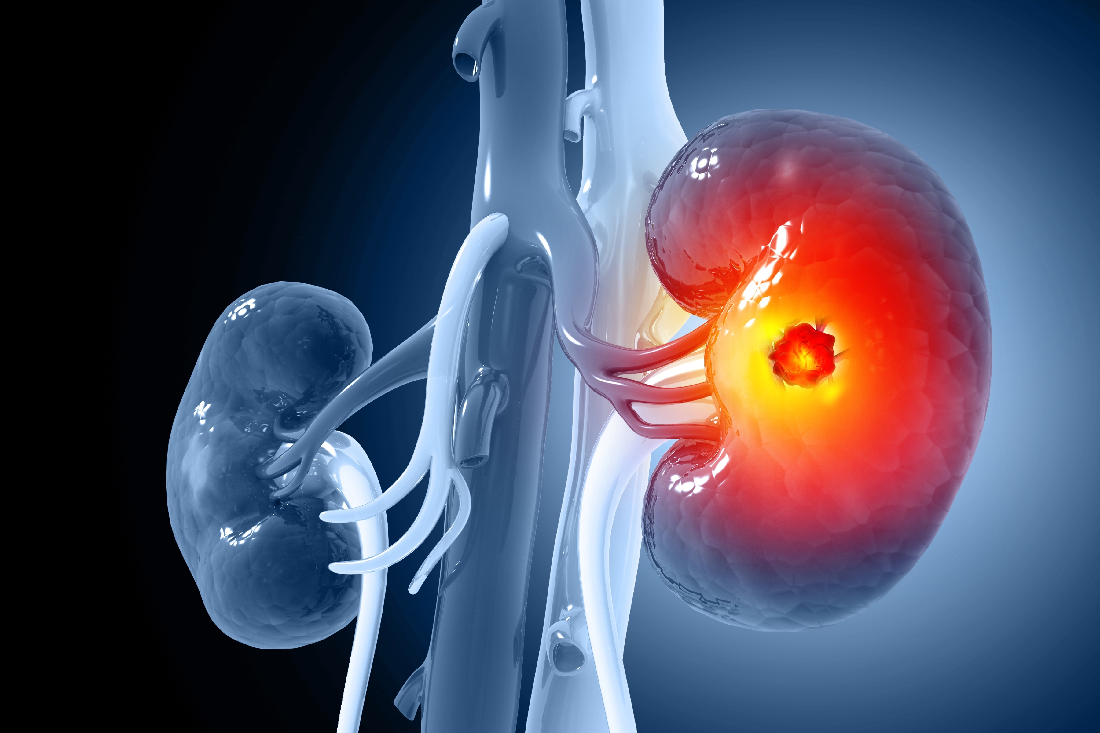 Kidney Cancer Treatment