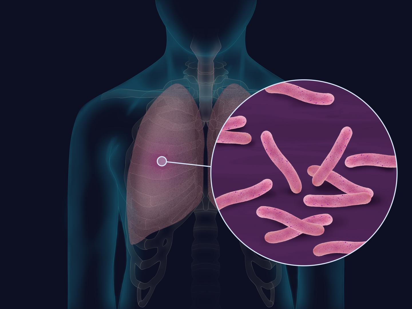 Respiratory Infection Treatment OneWelbeck Lung Health