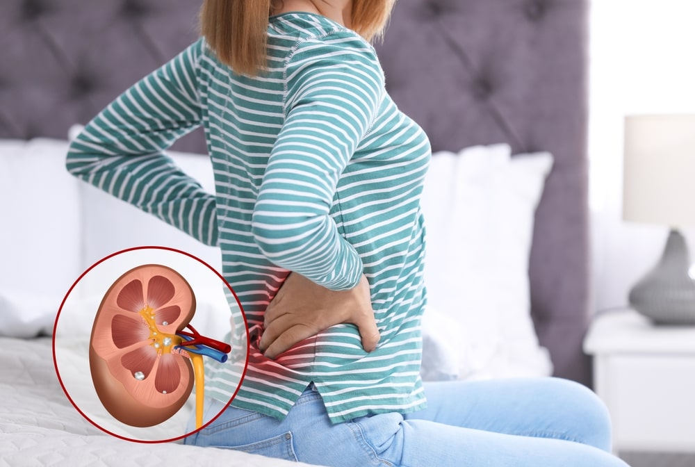 Kidney Stones Diagram - OneWelbeck