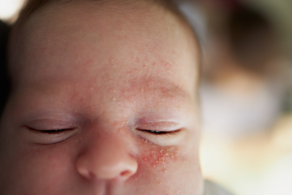 Neonatal acne child skin specialist - OneWelbeck