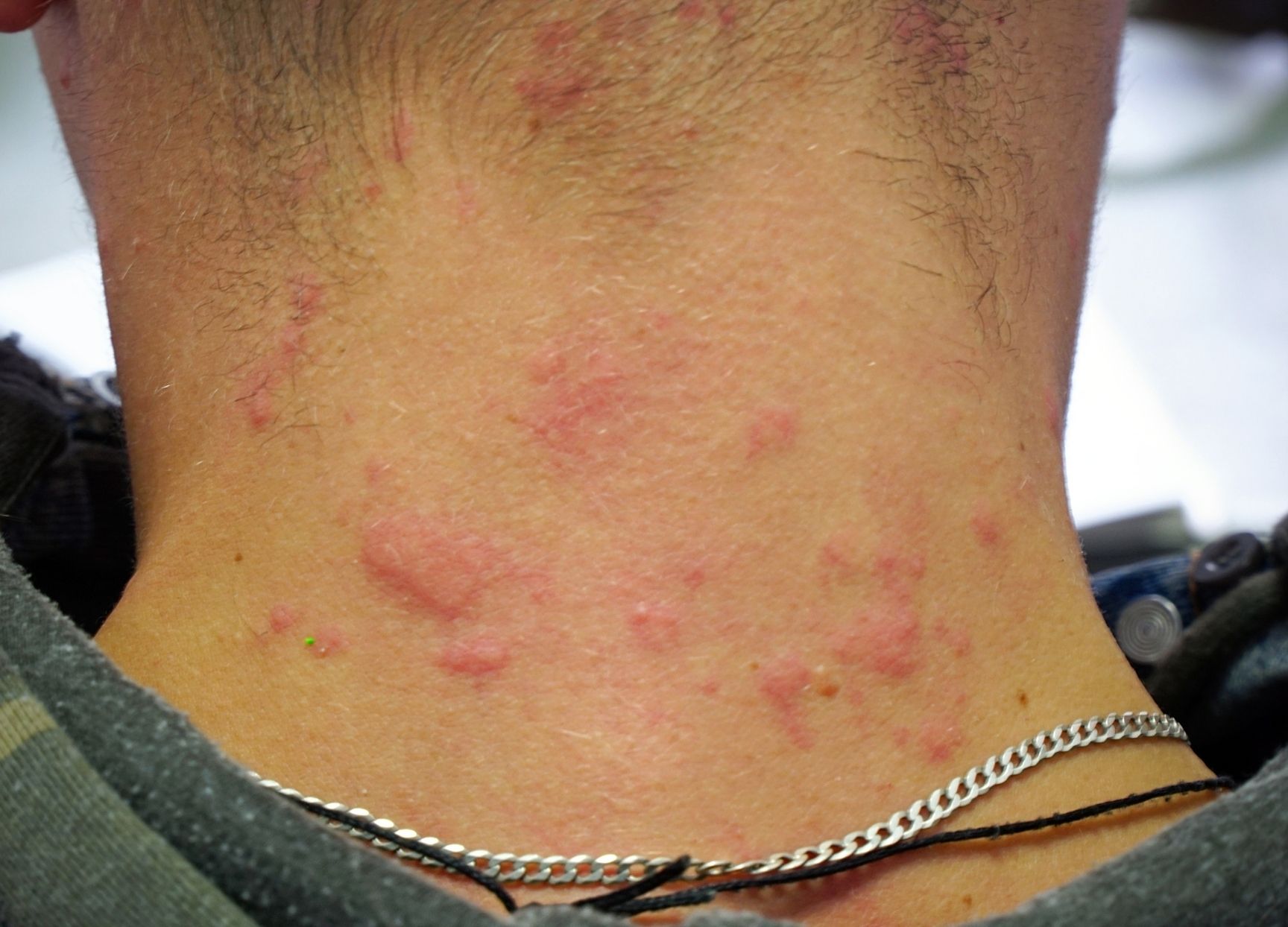Urticaria (hives)