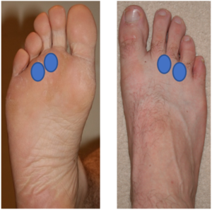 what-is-a-morton-s-neuroma-causes-treatm