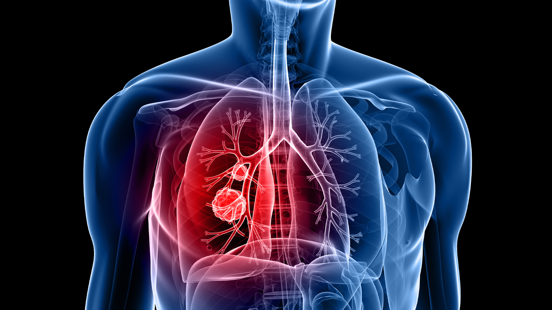 What Does A Lung Infection Mean