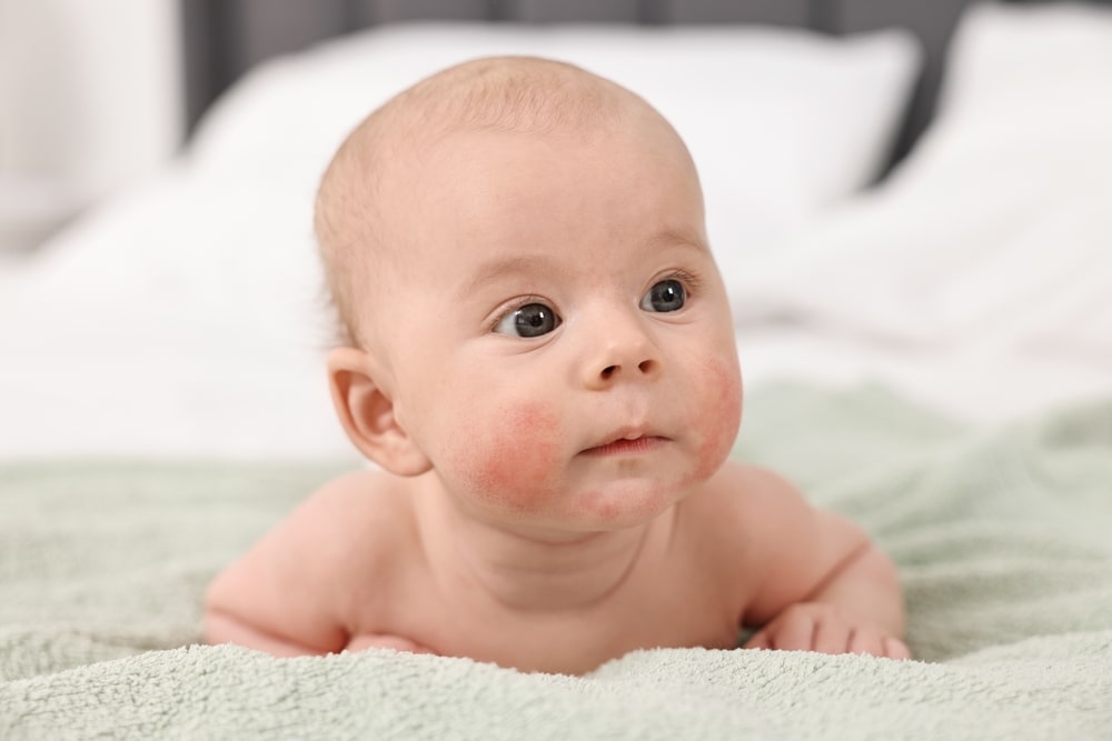 Eczema in newborns & children