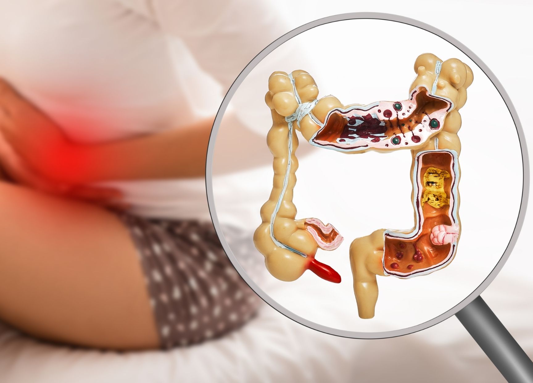 What is colitis?