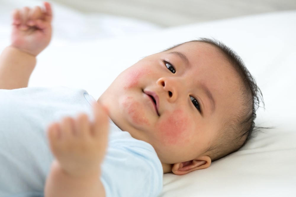 Skin and scalp infection treatment with a infant skin specialist - OneWelbeck