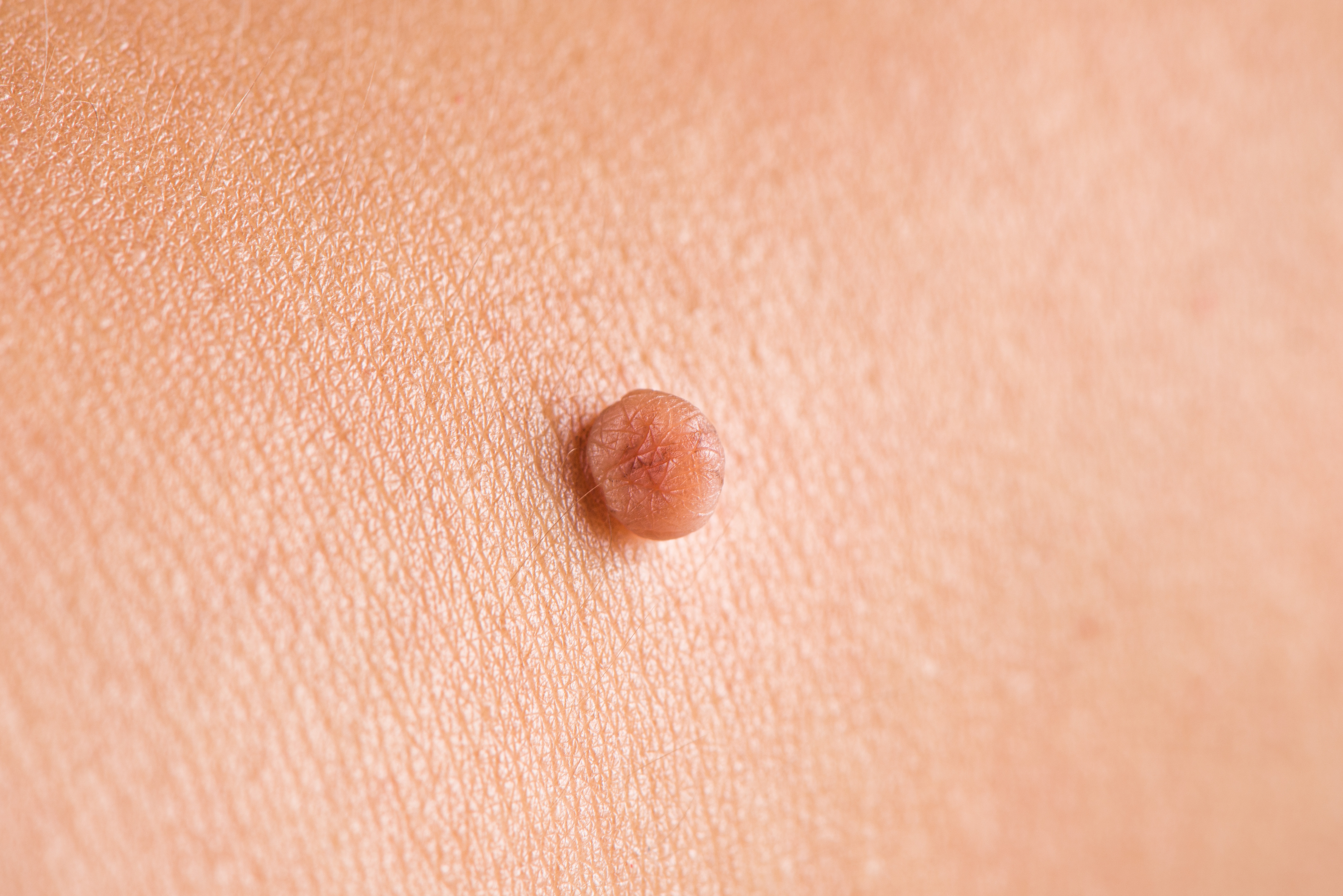 Skin Tag vs Haemorrhoid - OneWelbeck
