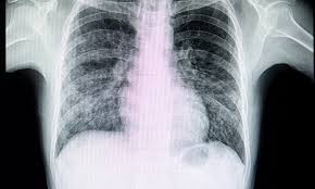 Chest X-ray